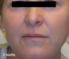 4 months sculptra