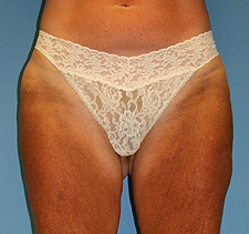slim lipo before