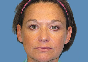 Restylane Botox After