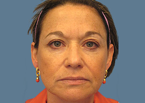 Restylane Botox Before