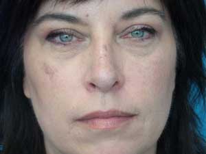 botox liquid facelift