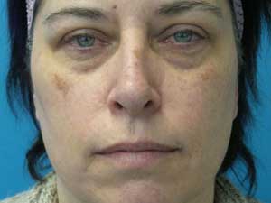 botox facelift