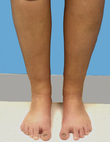 calf liposuction - after