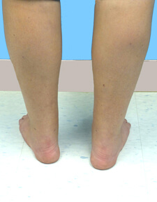 calf lipo after