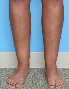 calf liposuction - before