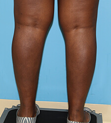 calf liposuction - after