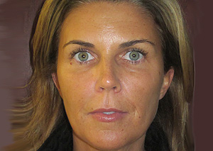 Restylane-L, Perlane and Botox After