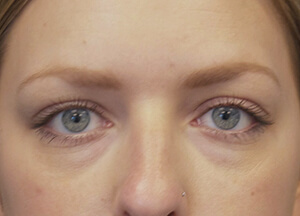 Restylane tear trough before