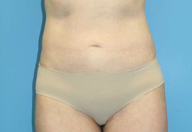 Liposuction in Boston, Hingham & Nantucket, MA