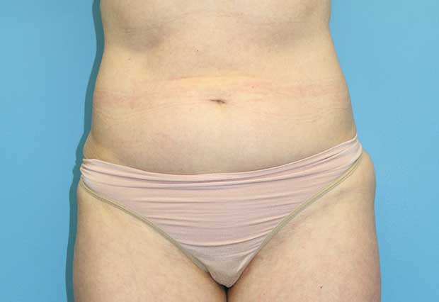 Abdominal Liposuction - Boston, South Shore, Cape Cod
