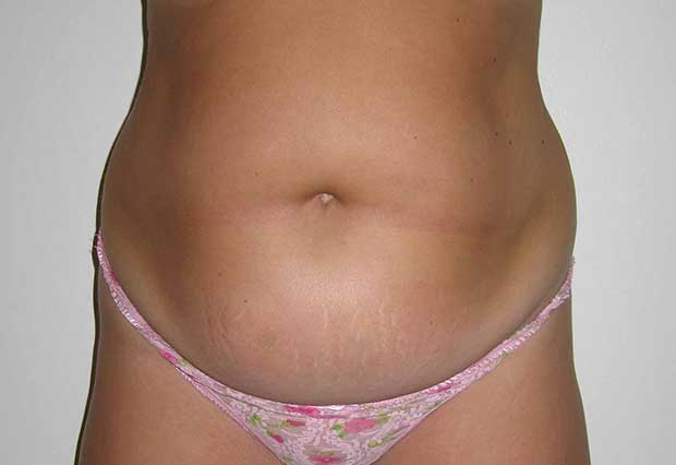 Drainless Tummy Tuck Abdominoplasty - Christine Hamori - Boston South Shore