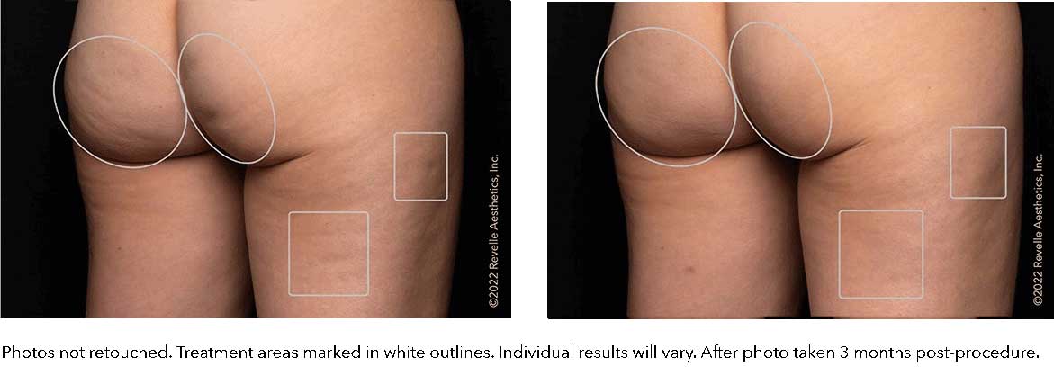 Cellulite Reduction Treatments  The American Board of Cosmetic